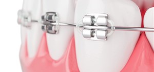 Maintaining Oral Health with Braces