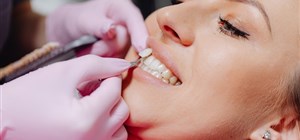 Veneers – Our Dentists in Cape Town Explain