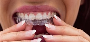 Introducing Invisalign in Cape Town - Everything You Need to Know 