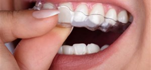 Variations, Types, and Time-Frames of the Invisalign System