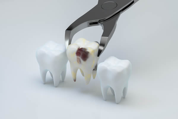 Teeth Extraction