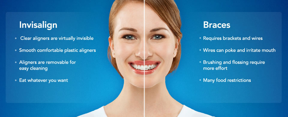 Invisalign vs Braces